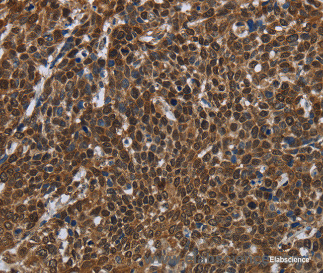 Immunohistochemistry of paraffin-embedded Human cervical cancer tissue using FASTKD2 Polyclonal Antibody at dilution 1:50