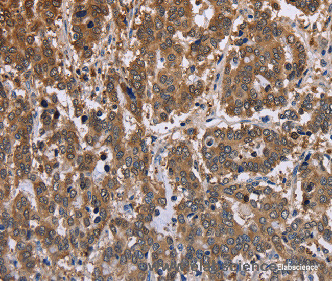 Immunohistochemistry of paraffin-embedded Human liver cancer tissue using FBP2 Polyclonal Antibody at dilution 1:40