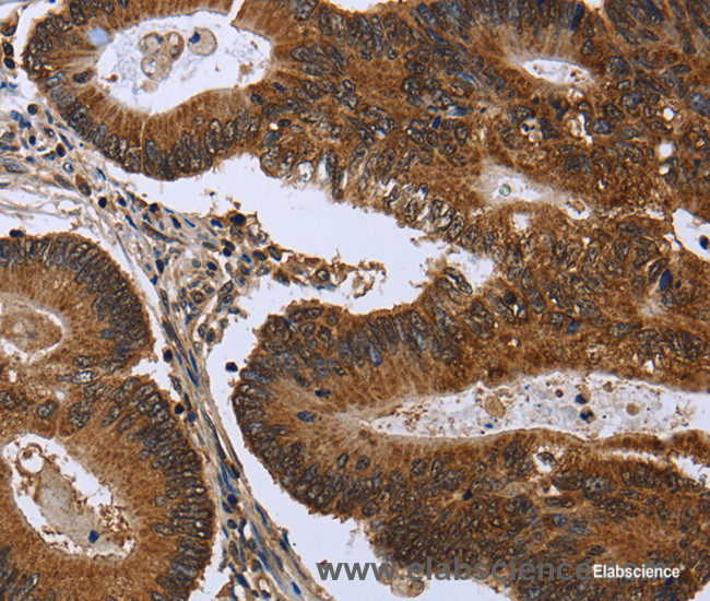 Immunohistochemistry of paraffin-embedded Human colon cancer tissue using FGFR1OP Polyclonal Antibody at dilution 1:50