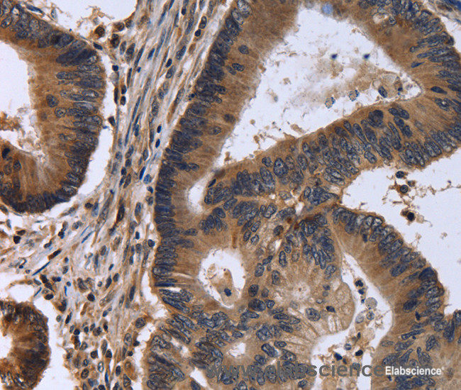 Immunohistochemistry of paraffin-embedded Human colon cancer tissue using FSTL1 Polyclonal Antibody at dilution 1:30