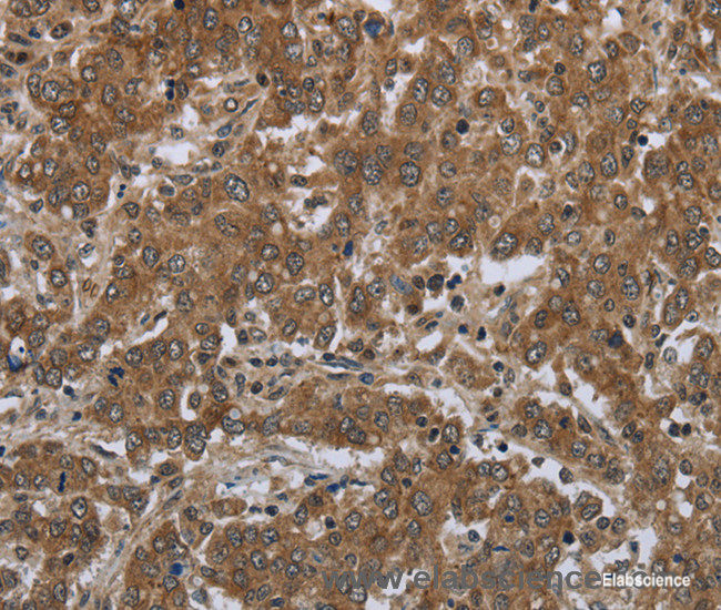 Immunohistochemistry of paraffin-embedded Human liver cancer tissue using GABRB1 Polyclonal Antibody at dilution 1:50