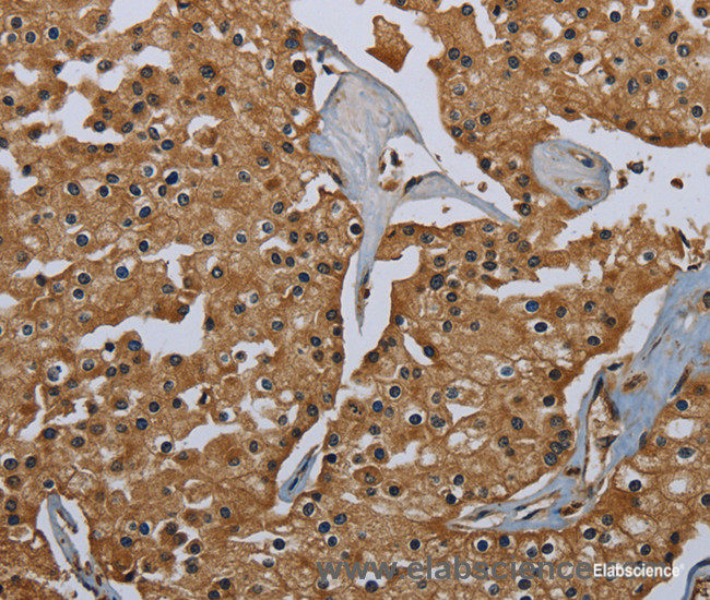 Immunohistochemistry of paraffin-embedded Human prostate cancer tissue using GBP5 Polyclonal Antibody at dilution 1:40