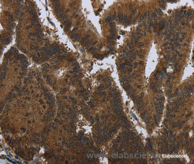 Immunohistochemistry of paraffin-embedded Human colon cancer tissue using PIP Polyclonal Antibody at dilution 1:50
