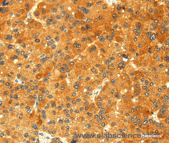 Immunohistochemistry of paraffin-embedded Human liver cancer tissue using GK1 Polyclonal Antibody at dilution 1:60