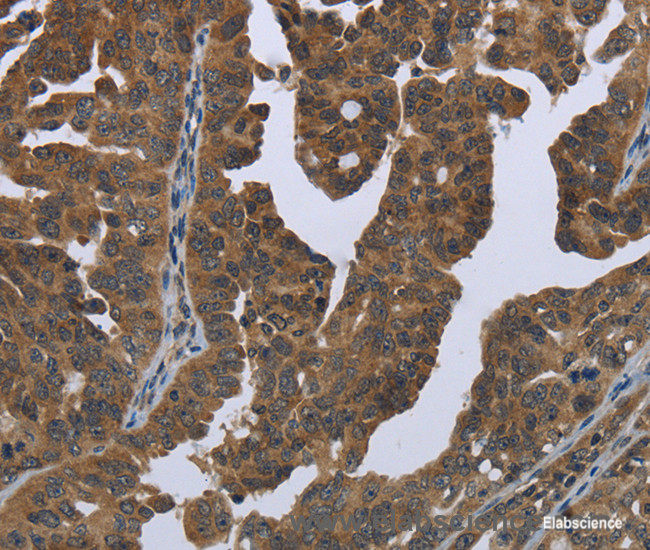 Immunohistochemistry of paraffin-embedded Human ovarian cancer tissue using GYS2 Polyclonal Antibody at dilution 1:50