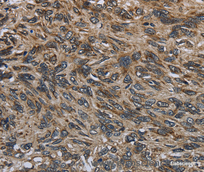 Immunohistochemistry of paraffin-embedded Human esophagus cancer tissue using CD236 Polyclonal Antibody at dilution 1:60