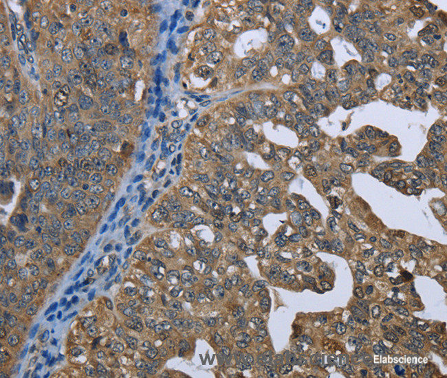 Immunohistochemistry of paraffin-embedded Human ovarian cancer tissue using GPAM Polyclonal Antibody at dilution 1:60