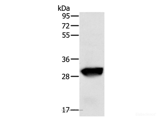 Western Blot analysis of Human liver cancer tissue using GSTO1 Polyclonal Antibody at dilution of 1:200