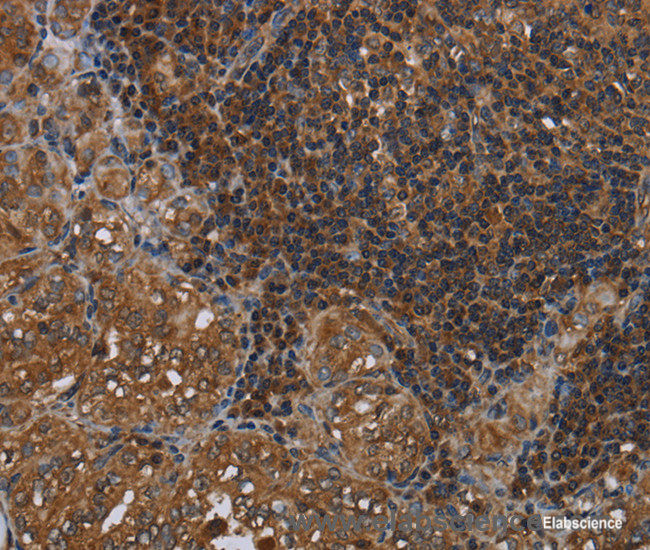 Immunohistochemistry of paraffin-embedded Human thyroid cancer tissue using HOMER2 Polyclonal Antibody at dilution 1:40