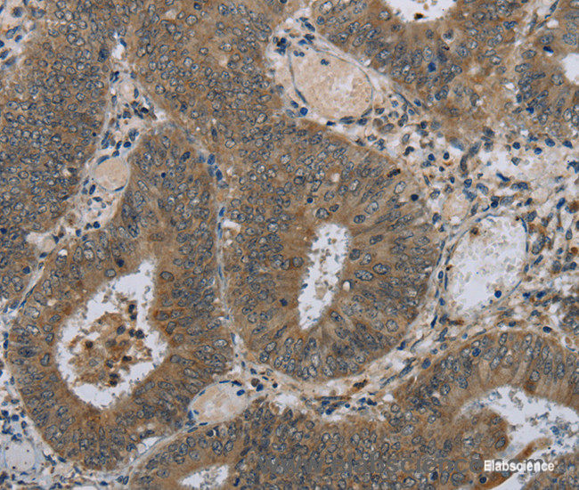 Immunohistochemistry of paraffin-embedded Human colon cancer tissue using HSD3B1 Polyclonal Antibody at dilution 1:40