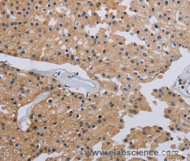 Immunohistochemistry of paraffin-embedded Human prostate cancer tissue using HSD3B7 Polyclonal Antibody at dilution 1:40