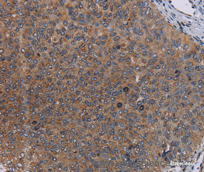 Immunohistochemistry of paraffin-embedded Human renal cancer tissue using LIPE Polyclonal Antibody at dilution 1:50