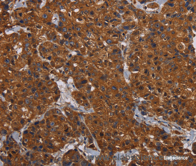 Immunohistochemistry of paraffin-embedded Human breast cancer tissue using HYAL2 Polyclonal Antibody at dilution 1:60