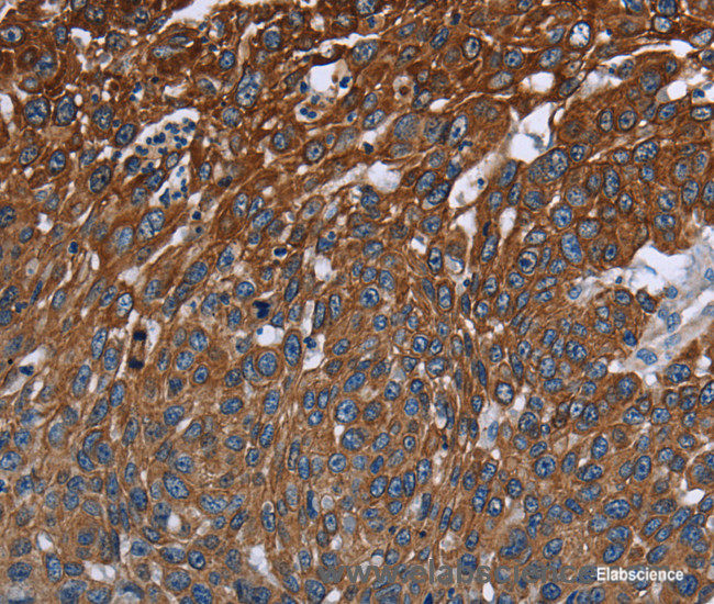 Immunohistochemistry of paraffin-embedded Human lung cancer tissue using FCGR3A Polyclonal Antibody at dilution 1:40