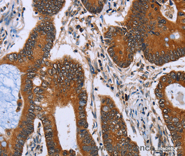 Immunohistochemistry of paraffin-embedded Human colon cancer tissue using IHH Polyclonal Antibody at dilution 1:30