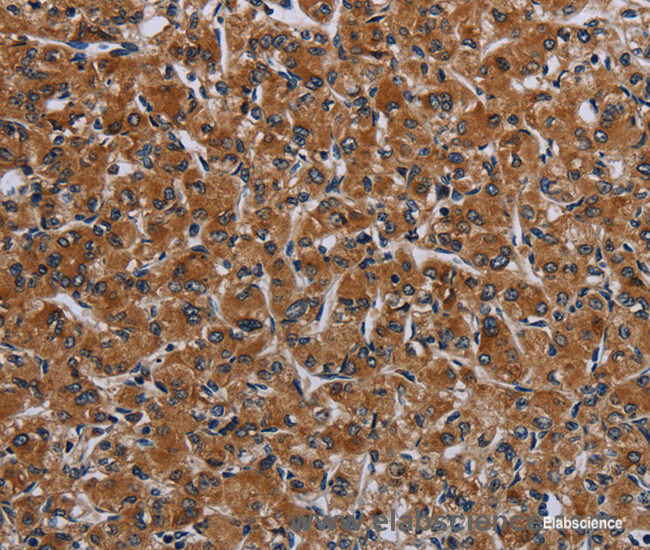 Immunohistochemistry of paraffin-embedded Human prostate cancer tissue using IRGM Polyclonal Antibody at dilution 1:50