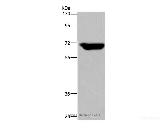 Western Blot analysis of Human breast infiltRative duct tissue using JMJD6 Polyclonal Antibody at dilution of 1:425