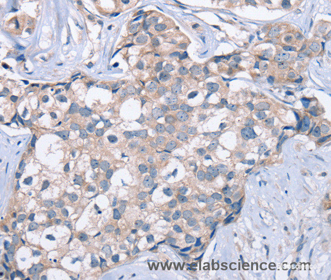 Immunohistochemistry of paraffin-embedded Human breast cancer tissue using KCNQ5 Polyclonal Antibody at dilution 1:60