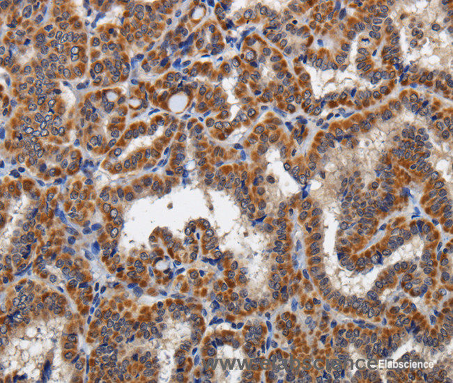 Immunohistochemistry of paraffin-embedded Human thyroid cancer tissue using KLK6 Polyclonal Antibody at dilution 1:60