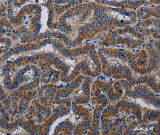 Immunohistochemistry of paraffin-embedded Human thyroid cancer tissue using KLK11 Polyclonal Antibody at dilution 1:40