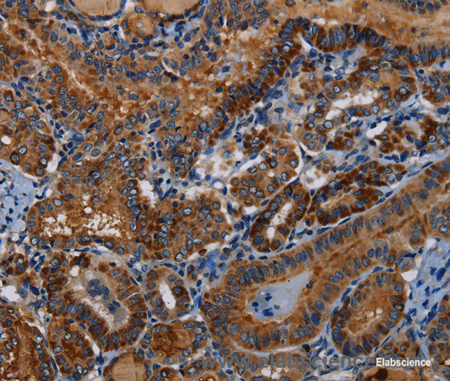Immunohistochemistry of paraffin-embedded Human thyroid cancer tissue using PIDD1 Polyclonal Antibody at dilution 1:30