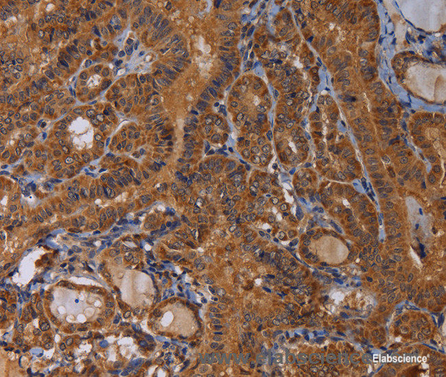 Immunohistochemistry of paraffin-embedded Human thyroid cancer tissue using MAGEB10 Polyclonal Antibody at dilution 1:60