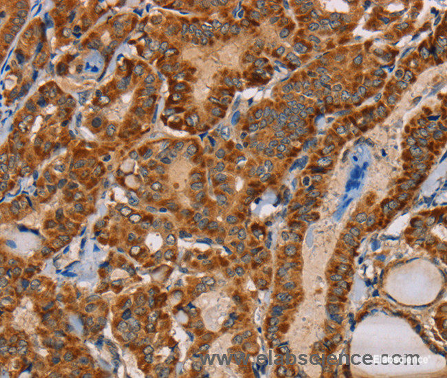 Immunohistochemistry of paraffin-embedded Human thyroid cancer tissue using MBNL3 Polyclonal Antibody at dilution 1:30