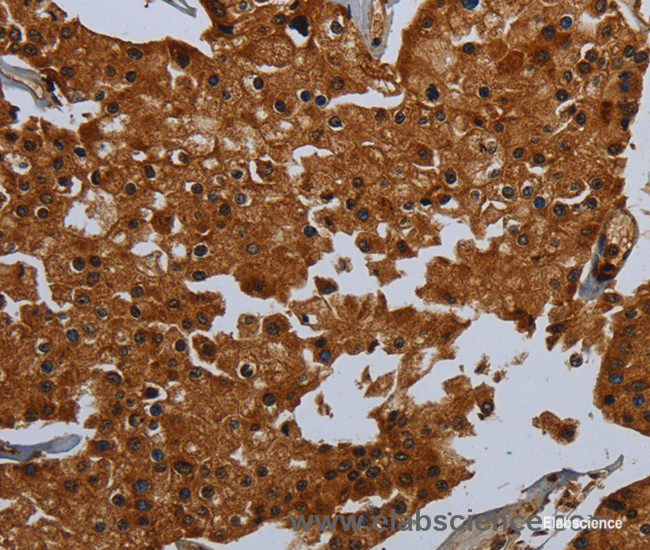 Immunohistochemistry of paraffin-embedded Human prostate cancer tissue using ENTPD7 Polyclonal Antibody at dilution 1:60