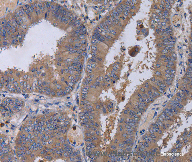 Immunohistochemistry of paraffin-embedded Human colon cancer tissue using MKKS Polyclonal Antibody at dilution 1:50