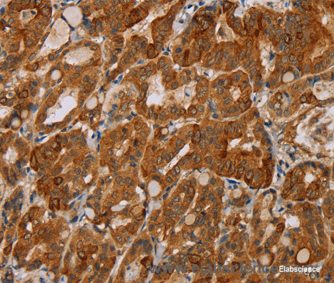 Immunohistochemistry of paraffin-embedded Human thyroid cancer tissue using MTUS1 Polyclonal Antibody at dilution 1:40