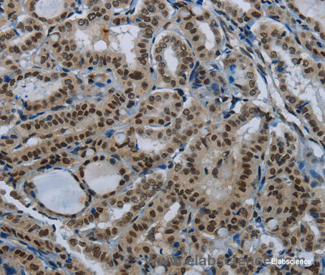Immunohistochemistry of paraffin-embedded Human thyroid cancer tissue using DAN Polyclonal Antibody at dilution 1:50