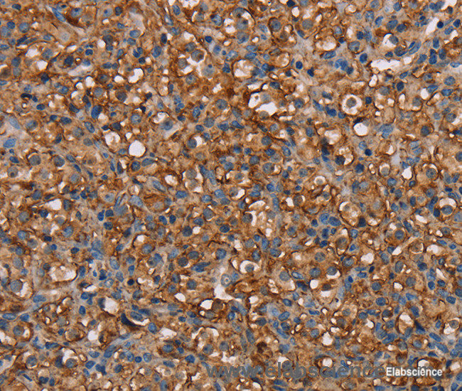 Immunohistochemistry of paraffin-embedded Human prostate cancer tissue using NEDD4L Polyclonal Antibody at dilution 1:60