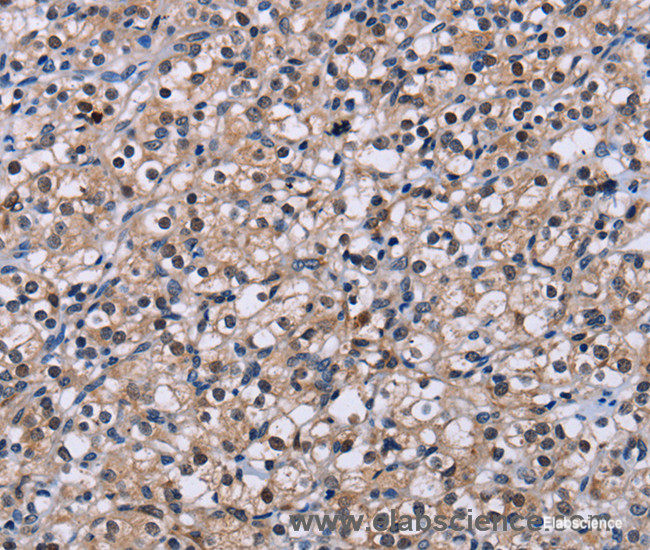 Immunohistochemistry of paraffin-embedded Human prostate cancer tissue using NR1D1 Polyclonal Antibody at dilution 1:60