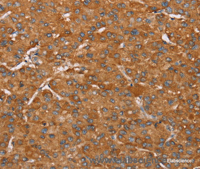 Immunohistochemistry of paraffin-embedded Human liver cancer tissue using PAGE5 Polyclonal Antibody at dilution 1:55