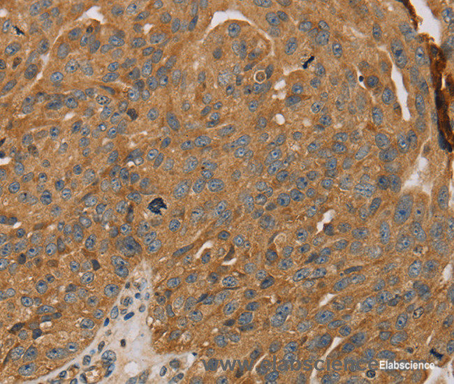 Immunohistochemistry of paraffin-embedded Human breast cancer tissue using PARP11 Polyclonal Antibody at dilution 1:30