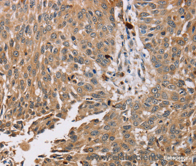 Immunohistochemistry of paraffin-embedded Human lung cancer tissue using PDLIM7 Polyclonal Antibody at dilution 1:35