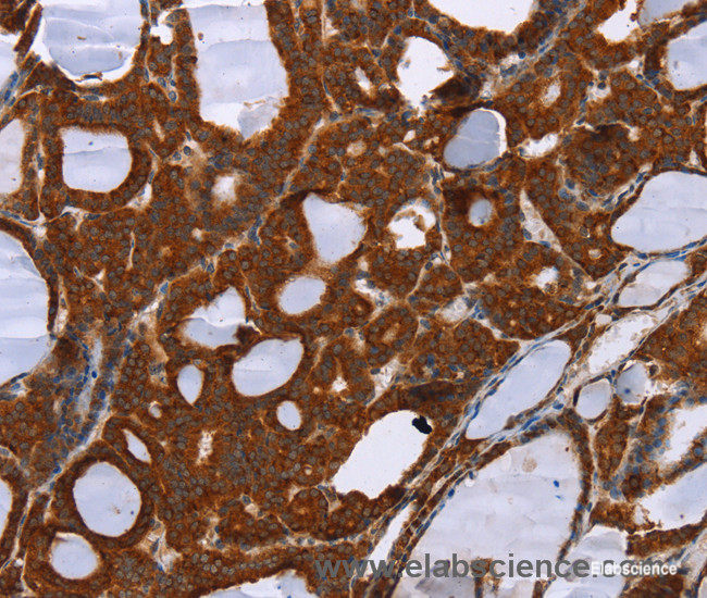 Immunohistochemistry of paraffin-embedded Human thyroid cancer tissue using PPP2R3C Polyclonal Antibody at dilution 1:30