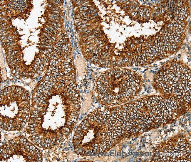 Immunohistochemistry of paraffin-embedded Human cervical cancer tissue using RAB25 Polyclonal Antibody at dilution 1:35