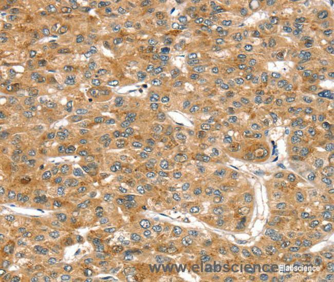 Immunohistochemistry of paraffin-embedded Human liver cancer tissue using RASSF9 Polyclonal Antibody at dilution 1:45