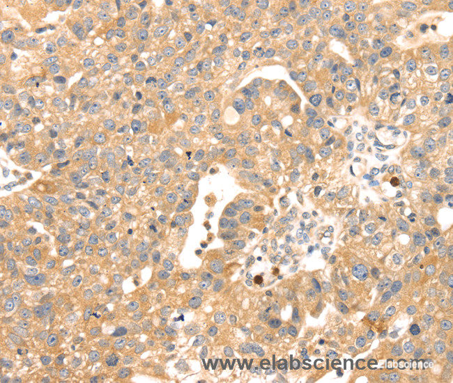 Immunohistochemistry of paraffin-embedded Human breast cancer tissue using S100A12 Polyclonal Antibody at dilution 1:45