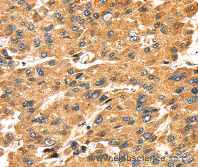Immunohistochemistry of paraffin-embedded Human liver cancer tissue using SH3KBP1 Polyclonal Antibody at dilution 1:45