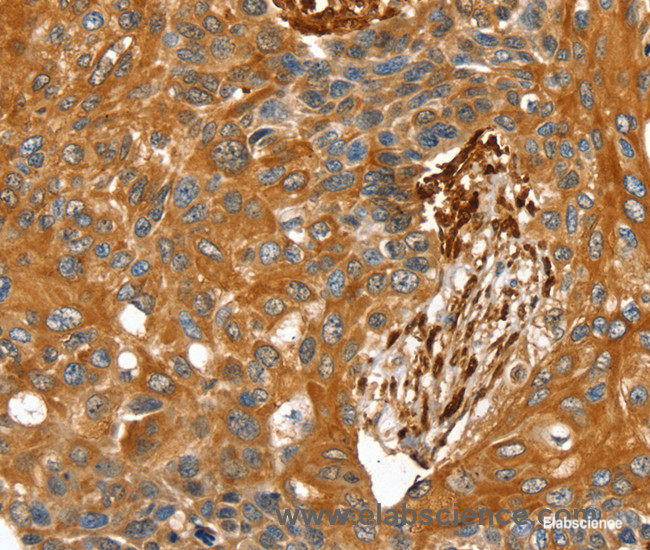 Immunohistochemistry of paraffin-embedded Human esophagus cancer tissue using TAGLN Polyclonal Antibody at dilution 1:30
