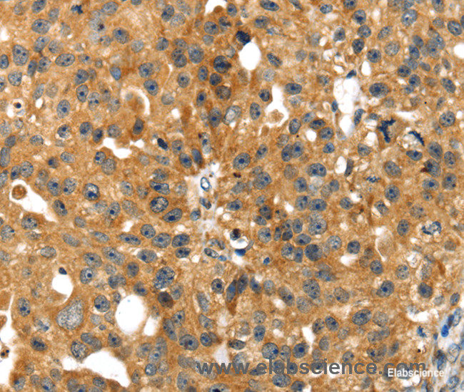 Immunohistochemistry of paraffin-embedded Human breast cancer tissue using SMYD4 Polyclonal Antibody at dilution 1:40