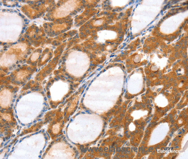 Immunohistochemistry of paraffin-embedded Human thyroid cancer tissue using SRGAP3 Polyclonal Antibody at dilution 1:40