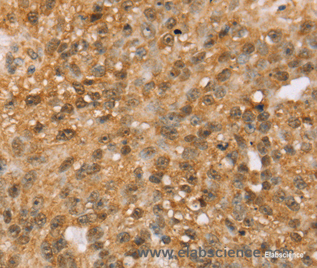 Immunohistochemistry of paraffin-embedded Human breast cancer tissue using MED22 Polyclonal Antibody at dilution 1:50