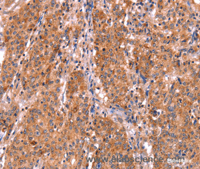 Immunohistochemistry of paraffin-embedded Human gasrtic cancer tissue using ABI1 Polyclonal Antibody at dilution 1:40