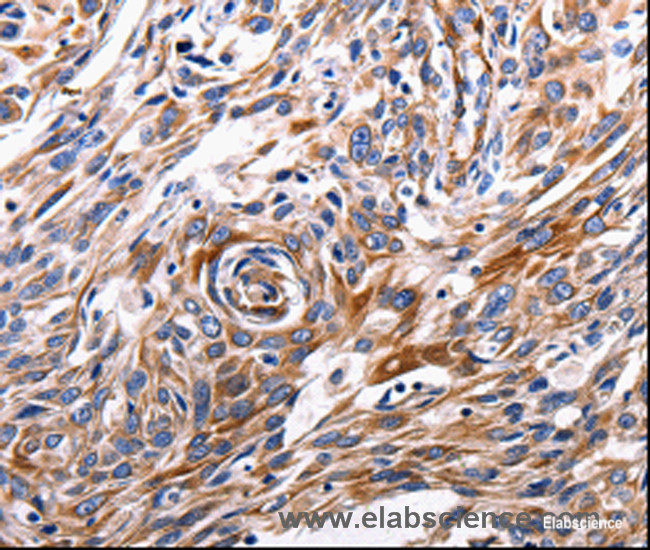 Immunohistochemistry of paraffin-embedded Human esophagus cancer tissue using ACE2 Polyclonal Antibody at dilution 1:200