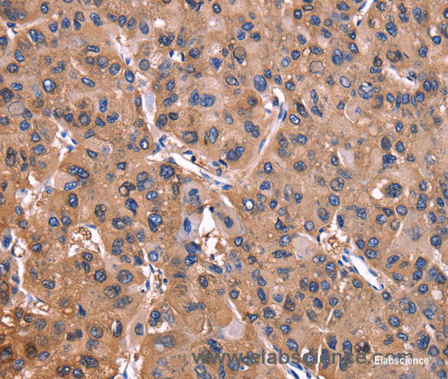 Immunohistochemistry of paraffin-embedded Human liver cancer tissue using ADM2 Polyclonal Antibody at dilution 1:40