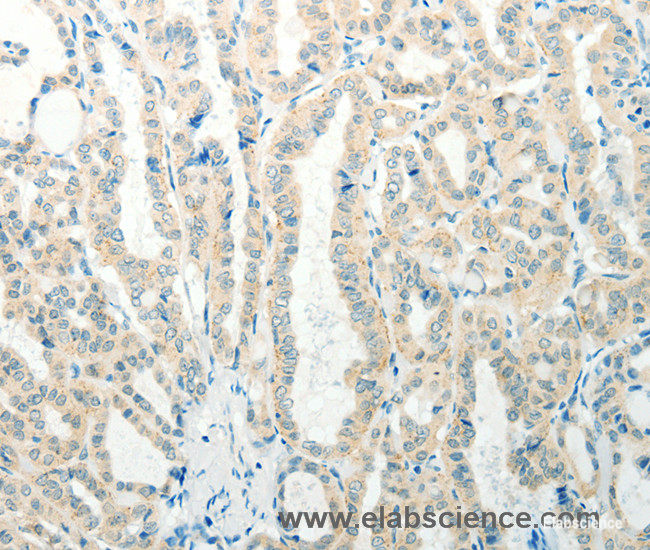 Immunohistochemistry of paraffin-embedded Human thyroid cancer tissue using RAB25 Polyclonal Antibody at dilution 1:50