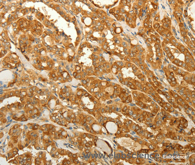 Immunohistochemistry of paraffin-embedded Human thyroid cancer tissue using RAB35 Polyclonal Antibody at dilution 1:50
